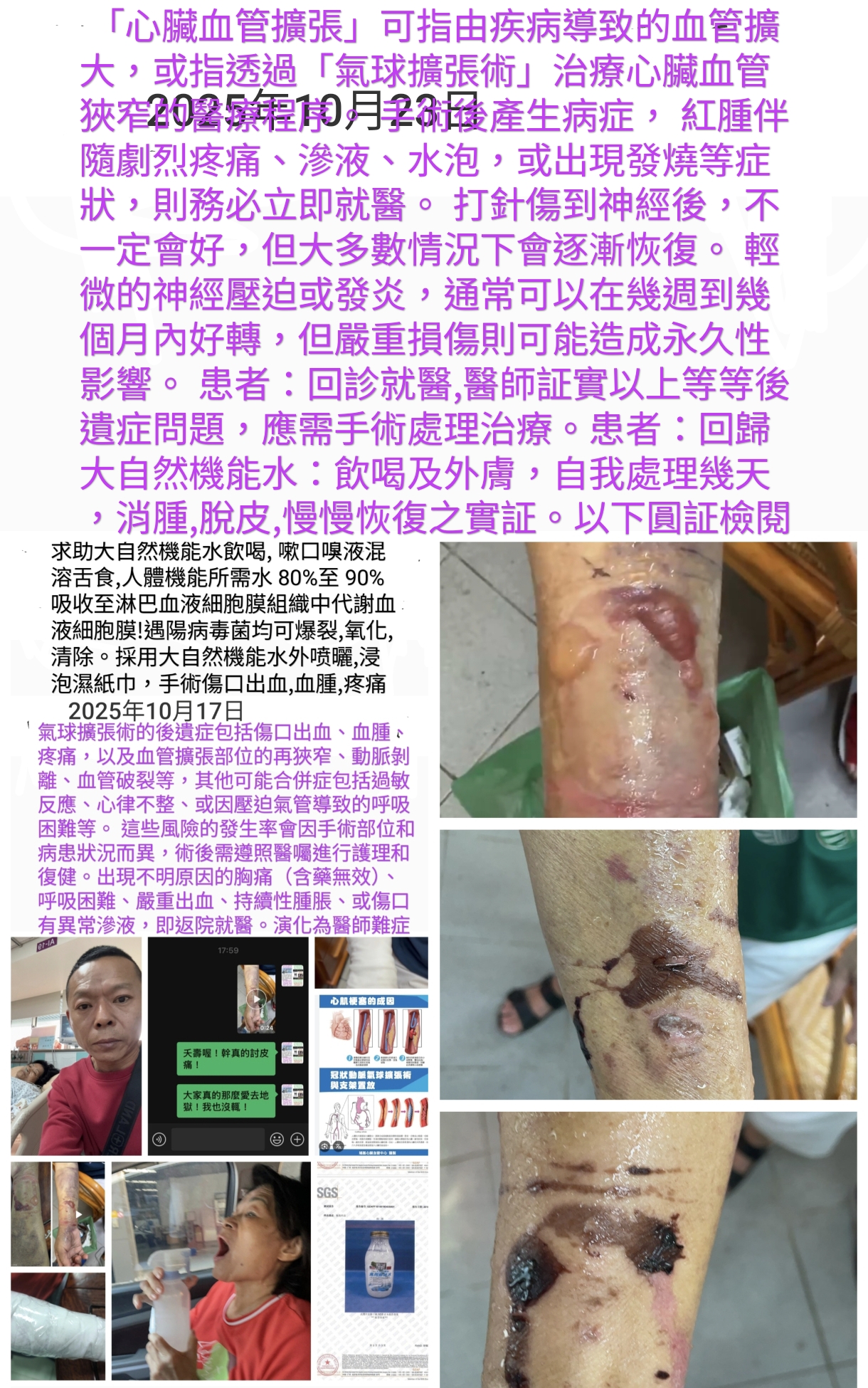 心藏血管擴張手術後遺症