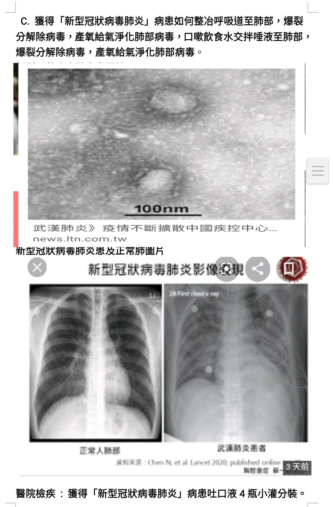 第二張武漢新型冠狀病毒肺炎